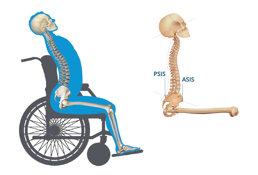 Anterior Pelvic Tilt Causes and Solutions through Wheelchair Positioning